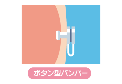 胃ろうの方の介護方法は 胃ろうのメリット デメリットも解説 フランスベッド